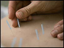 Acupuncture