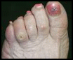 Chiropody - Corns
