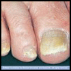 Chiropody - Fungal Nail